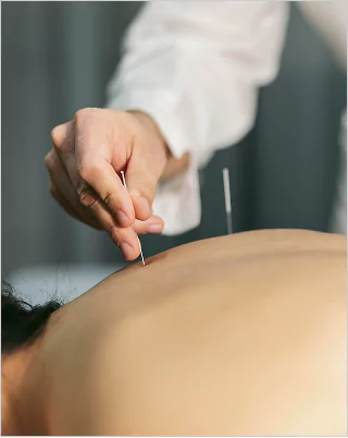 Dry needling